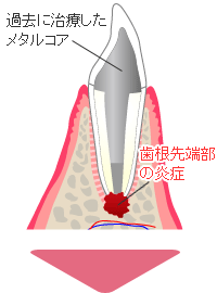 根尖性歯周炎