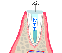 感染根管を殺菌・無菌化