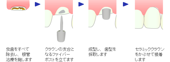 Ｃ２レベルの虫歯の治療例