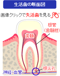 生活歯と失活歯の比較（断面図）