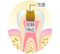 歯髄（歯の神経）が炎症を起こした虫歯