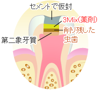 薬剤セット・仮封・経過観察