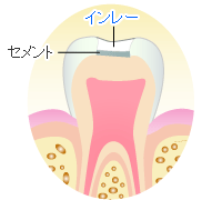 歯冠修復