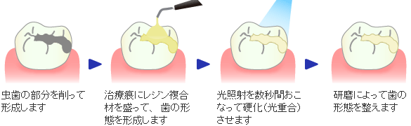 レジン充填法